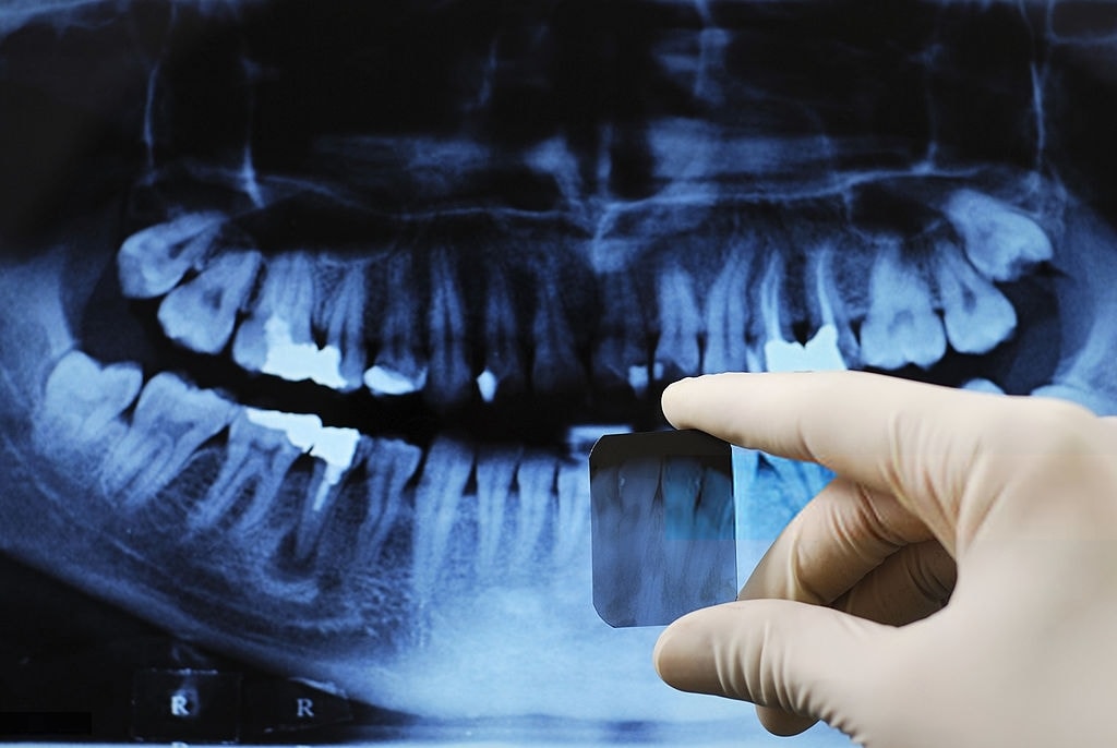 الأشعة السنية قبل تلبيس الأسنان