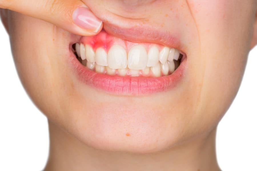Πόνος δοντιών μετά την εμφύτευση: περίοδος αποκατάστασης και μέθοδοι θεραπείας - TurkishWise