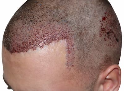 أضرار زراعة الشعر | الأثار الجانبية للعملية والمخاطر والمضاعفات الأكثر  شيوعاً - تركي ويز