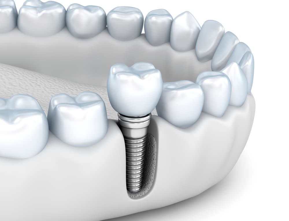I implants dentali facenu male?
