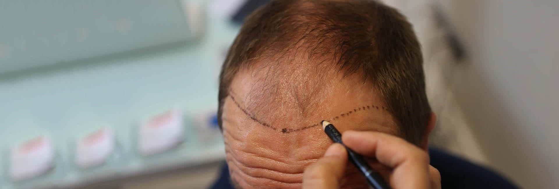 زراعة الشعر الطويل : لزراعة غير مكتشفة ونتائج سريعة - تركي ويز