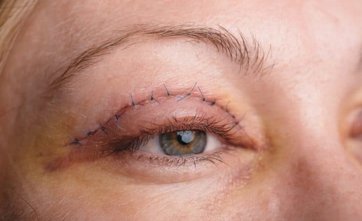 مخاطر عملية شد الجفون بين متطلبات الجمال وتحسين وظائف العين - تركي ويز