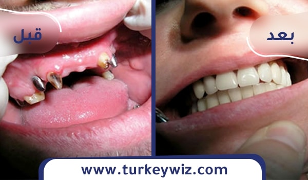 قبل وبعد زراعة الاسنان في تركيا