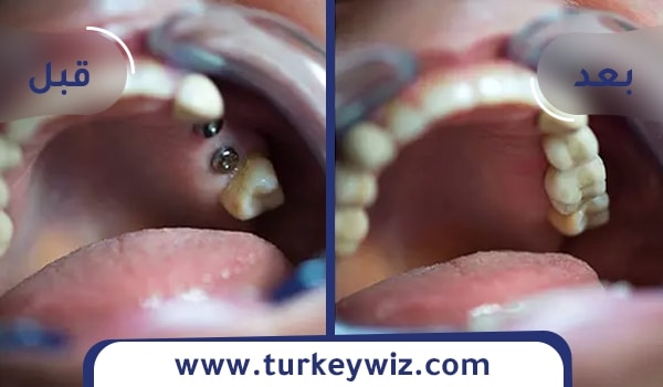 زراعة الاسنان الفورية في تركيا