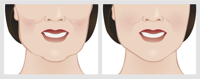 مقارنة الوجه قبل وبعد جراحة تجميل الذقن