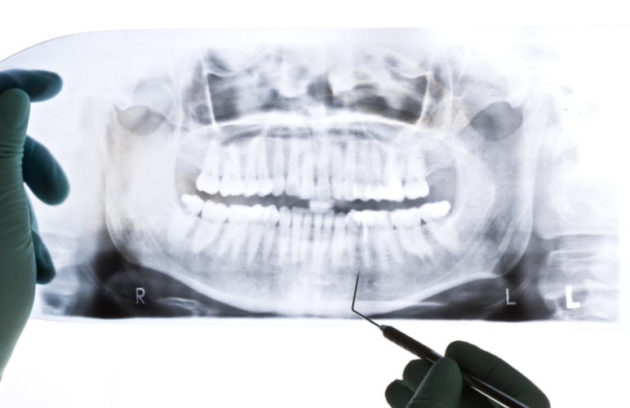 طبيب يفحص الأشعة السينية لمريض قد يحتاج الى زراعة عظام الأسنان