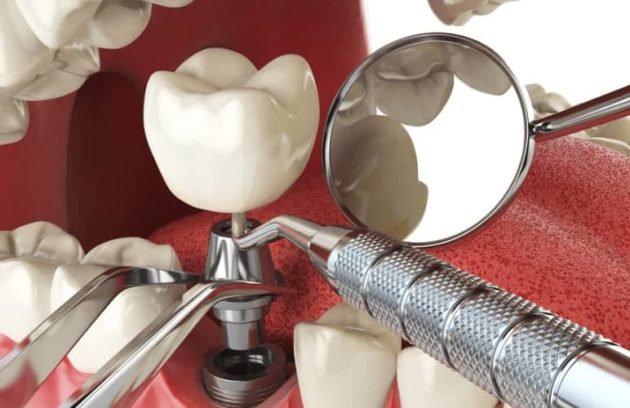 الجراحة الجيدة تمنع مخاطر زراعة الأسنان