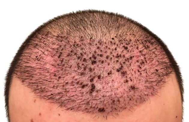 الاثار الجانبية لزراعة الشعر